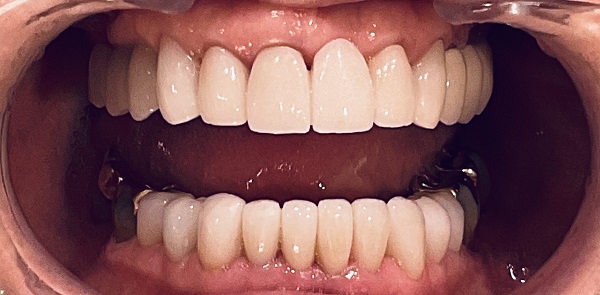 Up-close image of an open mouth showing all teeth